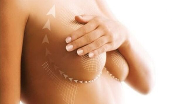 ridicare de sutură pentru mărirea sânilor