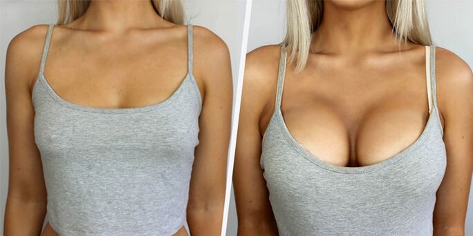 înainte și după o intervenție chirurgicală plastică pentru mărirea sânilor