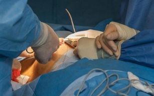 cum se efectuează intervenția chirurgicală de mărire a sânilor