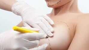 Chirurgie de mărire a sânilor
