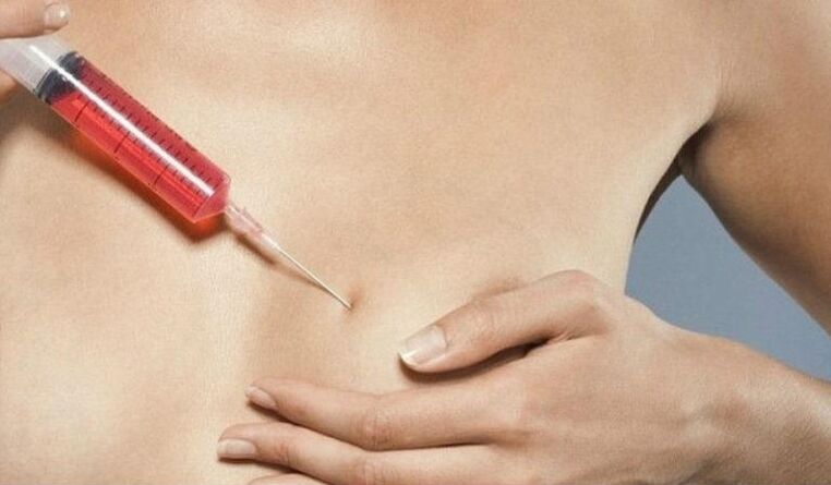 Mărirea sânilor cu injecții cu acid hialuronic