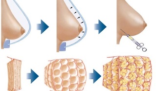 cum se efectuează procedura de mărire a sânilor cu grăsime
