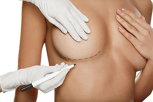 Marcarea cu un marker înainte de operația de mărire a sânilor